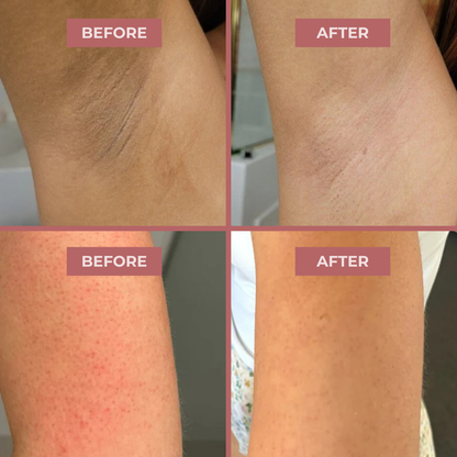 Body Peel Spray - Kojic + Gurkemeje